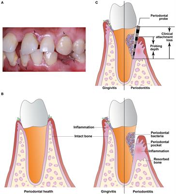 Role of Maternal Periodontitis in Preterm Birth